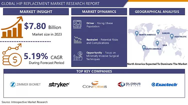 Hip Replacement Market - Comprehensive Study Report & Recent Trends